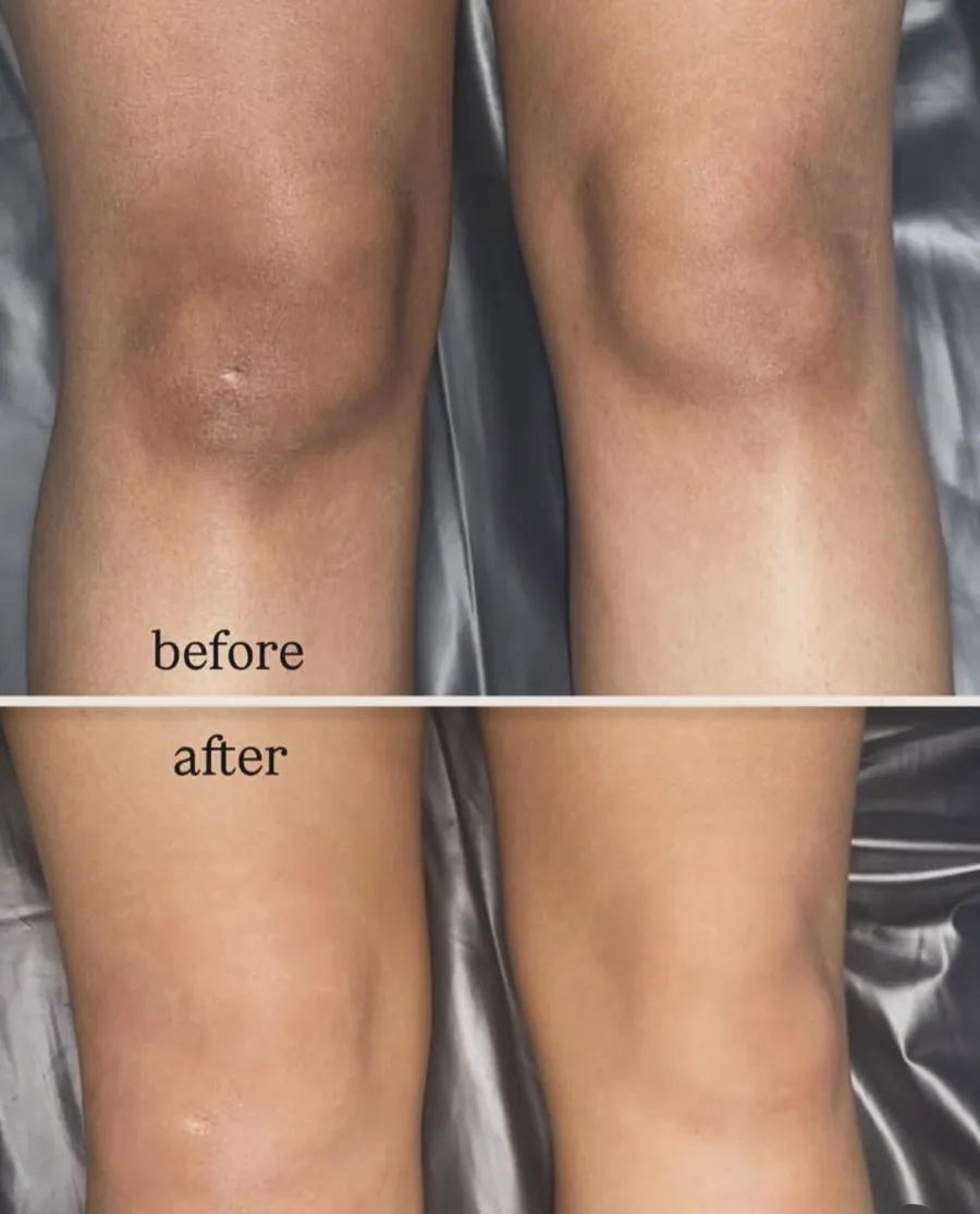 Skin Rejuvenation